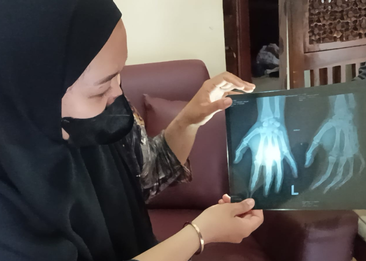 KETERANGAN FOTO : Seorang ibu rumah tangga berinisial AA saat menunjukkan hasil rongsen pada jari tangan yang akibat kekerasan fisik dilakukan suaminya berinisial SR. FOTO/RIZAL